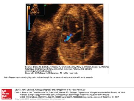 Color Doppler demonstrating high-velocity flow through the narrow aortic valve in a fetus with aortic stenosis. Source: Aortic Stenosis, Fetology: Diagnosis.