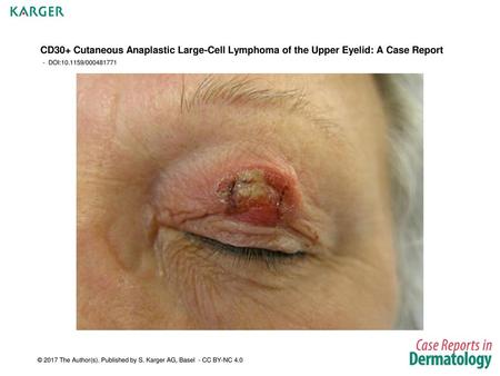 CD30+ Cutaneous Anaplastic Large-Cell Lymphoma of the Upper Eyelid: A Case Report - DOI:10.1159/000481771 Fig. 1. Clinical aspect of a primary cutaneous.