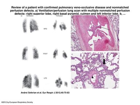 Review of a patient with confirmed pulmonary veno-occlusive disease and nonmatched perfusion defects. a) Ventilation/perfusion lung scan with multiple.