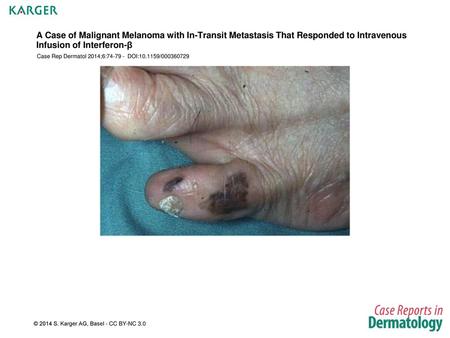 A Case of Malignant Melanoma with In-Transit Metastasis That Responded to Intravenous Infusion of Interferon-β Case Rep Dermatol 2014;6:74-79 - DOI:10.1159/000360729.