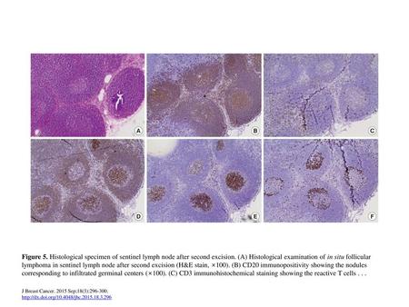 Figure 5. Histological specimen of sentinel lymph node after second excision. (A) Histological examination of in situ follicular lymphoma in sentinel lymph.