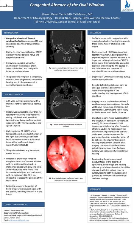 Congenital stapes suprastructure fixation presenting with