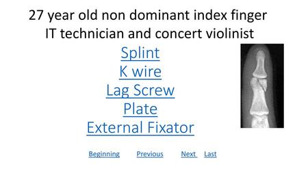 Splint K wire Lag Screw Plate External Fixator