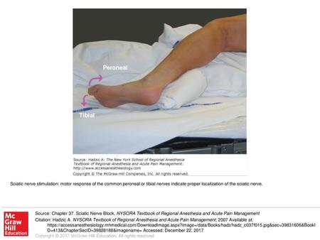 Sciatic nerve stimulation: motor response of the common peroneal or tibial nerves indicate proper localization of the sciatic nerve. Source: Chapter 37.