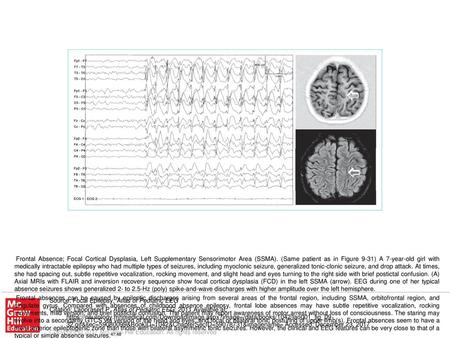 A case of Panayiotopoulos syndrome showing an atypical course - ppt ...