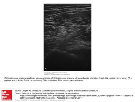 (A) Sciatic nerve anatomy (popliteal), ultrasound image