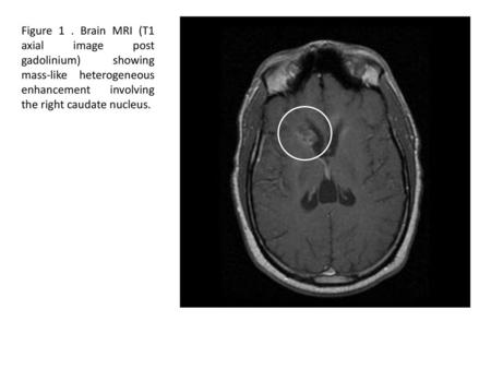 Figure 1 . Brain MRI (T1 axial image post gadolinium) showing mass-like heterogeneous enhancement involving the right caudate nucleus.