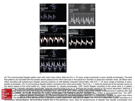 (A) The normal pulsed Doppler pattern seen with mitral valve inflow