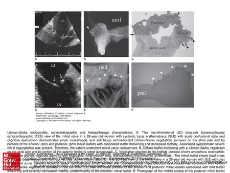 Libman-Sacks endocarditis: echocardiographic and histopathologic characteristics. A: This two-dimensional (2D) long-axis transesophageal echocardiographic.
