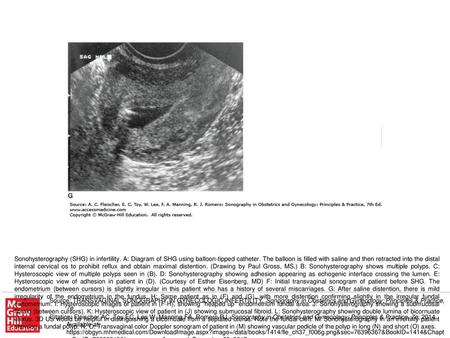 Sonohysterography (SHG) in infertility