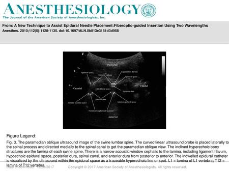 From: A New Technique to Assist Epidural Needle Placement:Fiberoptic-guided Insertion Using Two Wavelengths Anesthes. 2010;112(5):1128-1135. doi:10.1097/ALN.0b013e3181d3d958.