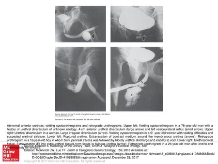 Abnormal anterior urethras: voiding cystourethrograms and retrograde urethrograms. Upper left: Voiding cystourethrogram in a 78-year-old man with a history.