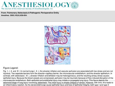 From: Pulmonary Atelectasis:A Pathogenic Perioperative Entity