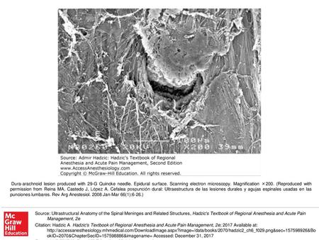 Dura-arachnoid lesion produced with 29-G Quincke needle