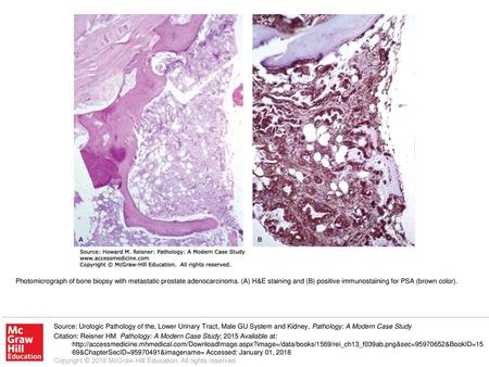 Photomicrograph of bone biopsy with metastatic prostate adenocarcinoma