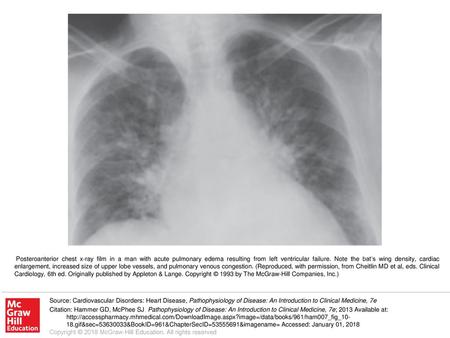 Posteroanterior chest x-ray film in a man with acute pulmonary edema resulting from left ventricular failure. Note the bat’s wing density, cardiac enlargement,