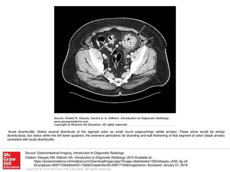 Acute diverticulitis. Notice several diverticula of the sigmoid colon as small round outpouchings (white arrows). These alone would be simply diverticulosis,