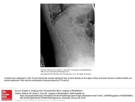 A lateral view radiograph in this 75-year-old female reveals significant loss of bone density as the upper lumbar and lower thoracic vertebral bodies are.
