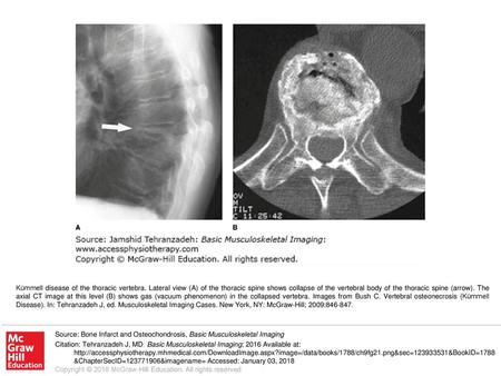 Kümmell disease of the thoracic vertebra