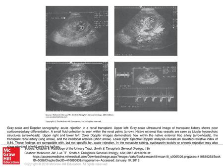 Gray-scale and Doppler sonography: acute rejection in a renal transplant. Upper left: Gray-scale ultrasound image of transplant kidney shows poor corticomedullary.