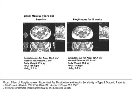 Figure 1. MRI study demonstrating the change in visceral and sc abdominal fat area in a typical pioglitazone-treated patient. Each picture shows a transverse.