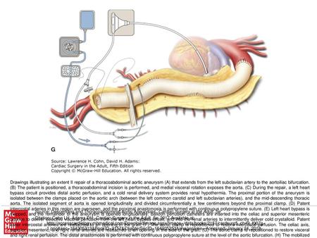 Drawings illustrating an extent II repair of a thoracoabdominal aortic aneurysm (A) that extends from the left subclavian artery to the aortoiliac bifurcation.