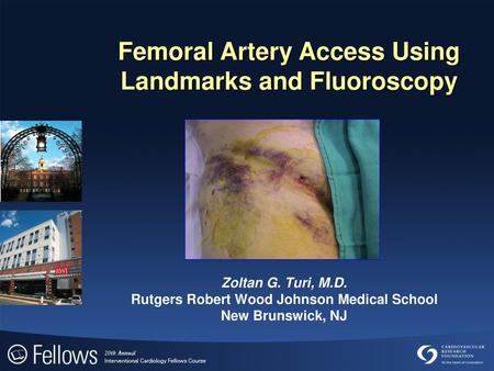 Femoral Artery Access Using Landmarks and Fluoroscopy