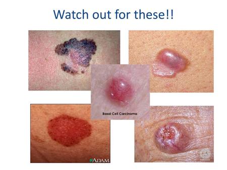Watch out for these!! BCC may appear as skin bump or growth that is: