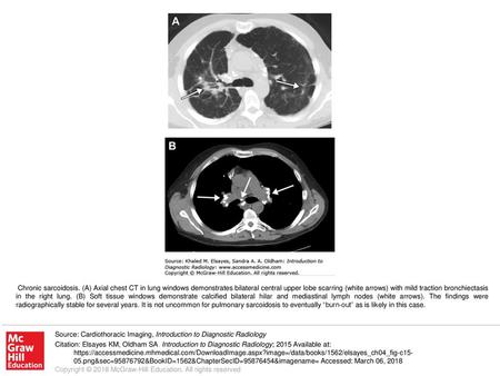 Chronic sarcoidosis. (A) Axial chest CT in lung windows demonstrates bilateral central upper lobe scarring (white arrows) with mild traction bronchiectasis.