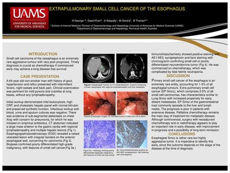 2epart EXTRAPULMONARY SMALL CELL CANCER OF THE ESOPHAGUS INTRODUCTION