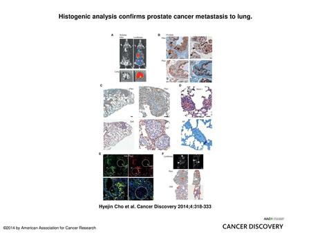 Histogenic analysis confirms prostate cancer metastasis to lung.