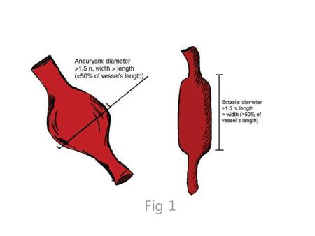 Figure 1. Schematic illustration of coronary aneurysm and ectasia