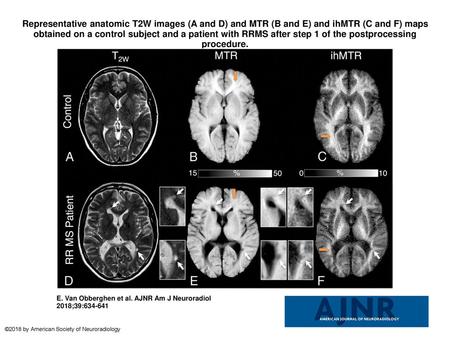 Representative anatomic T2W images (A and D) and MTR (B and E) and ihMTR (C and F) maps obtained on a control subject and a patient with RRMS after step.