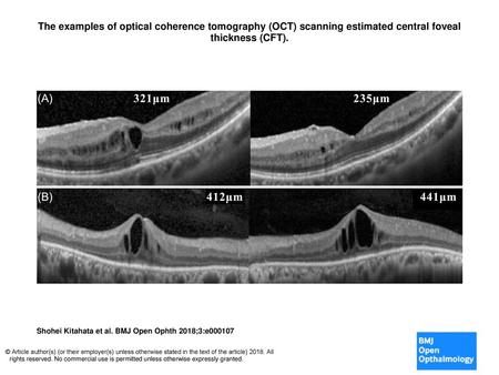The examples of optical coherence tomography (OCT) scanning estimated central foveal thickness (CFT). The examples of optical coherence tomography (OCT)