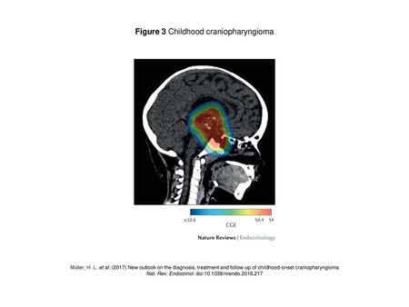 Figure 3 Childhood craniopharyngioma