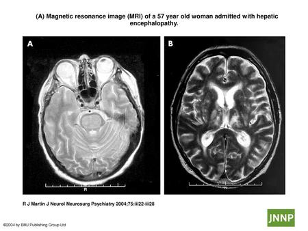  (A) Magnetic resonance image (MRI) of a 57 year old woman admitted with hepatic encephalopathy.  (A) Magnetic resonance image (MRI) of a 57 year old woman.