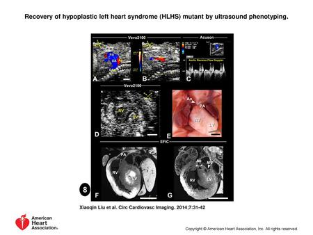 Recovery of hypoplastic left heart syndrome (HLHS) mutant by ultrasound phenotyping. Recovery of hypoplastic left heart syndrome (HLHS) mutant by ultrasound.