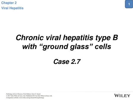 Chronic viral hepatitis type B with “ground glass” cells
