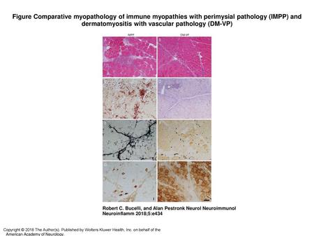 Figure Comparative myopathology of immune myopathies with perimysial pathology (IMPP) and dermatomyositis with vascular pathology (DM-VP)‏ Comparative.