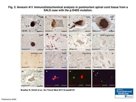 Fig. 2. Annexin A11 immunohistochemical analysis in postmortem spinal cord tissue from a SALS case with the p.D40G mutation. Annexin A11 immunohistochemical.