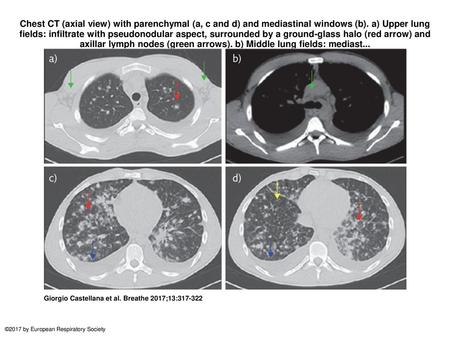 Chest CT (axial view) with parenchymal (a, c and d) and mediastinal windows (b). a) Upper lung fields: infiltrate with pseudonodular aspect, surrounded.