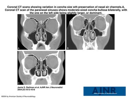 Coronal CT scans showing variation in concha size wth preservation of nasal air channels.A, Coronal CT scan of the paranasal sinuses shows moderate-sized.