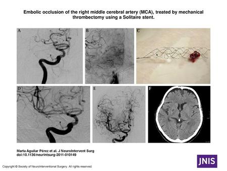 Embolic occlusion of the right middle cerebral artery (MCA), treated by mechanical thrombectomy using a Solitaire stent. Embolic occlusion of the right.