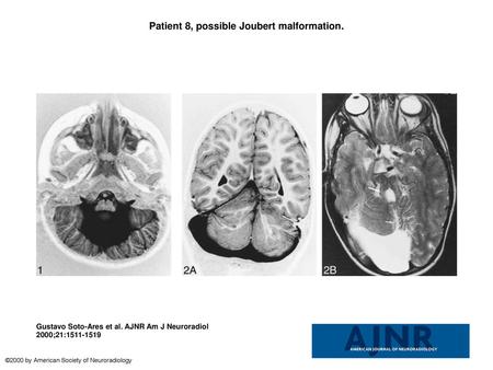 Patient 8, possible Joubert malformation.