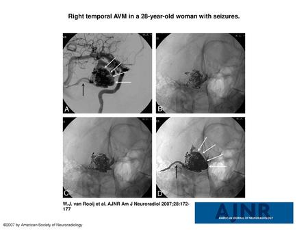 Right temporal AVM in a 28-year-old woman with seizures.