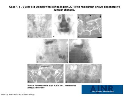 Case 1, a 76-year-old woman with low back pain