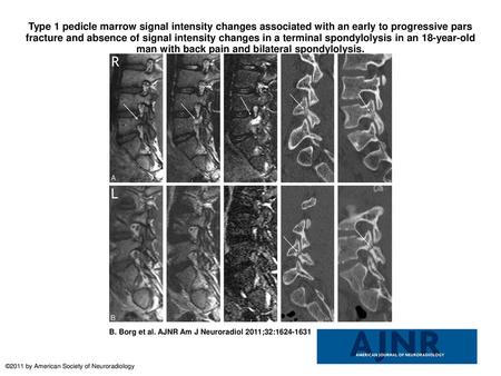 Type 1 pedicle marrow signal intensity changes associated with an early to progressive pars fracture and absence of signal intensity changes in a terminal.