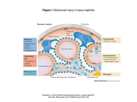 Figure 1 Glomerular injury in lupus nephritis