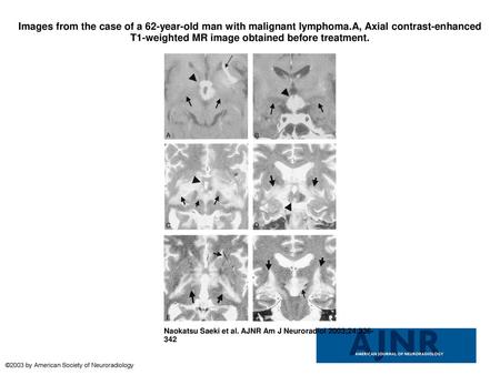 Images from the case of a 62-year-old man with malignant lymphoma