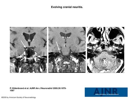 Evolving cranial neuritis.
